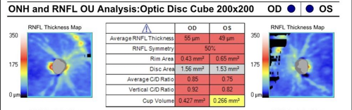 Figure 1. Patient’s OCT RNFL revealed significant global thinning of 55µm OD and 49µm OS, and an average cup-to-disc ratio of 0.85 OD and 0.75 OS.