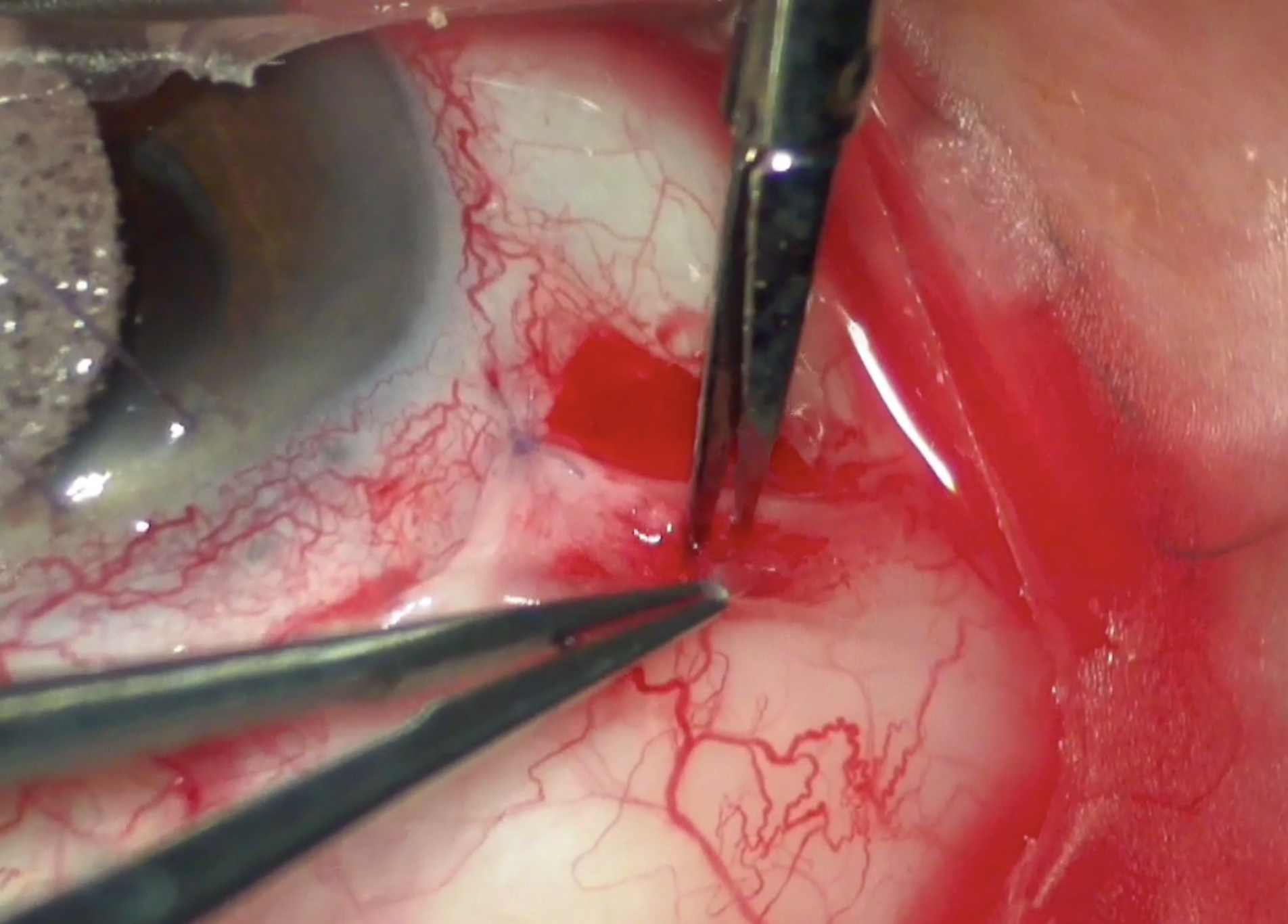 Tenon's Window in Xen Gel Stent Revision