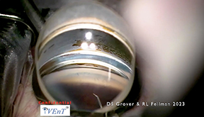 Surgical Video of the iVent Procedure