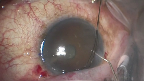 Technique to Address an Overfiltering Trabeculectomy Flap During Surgery