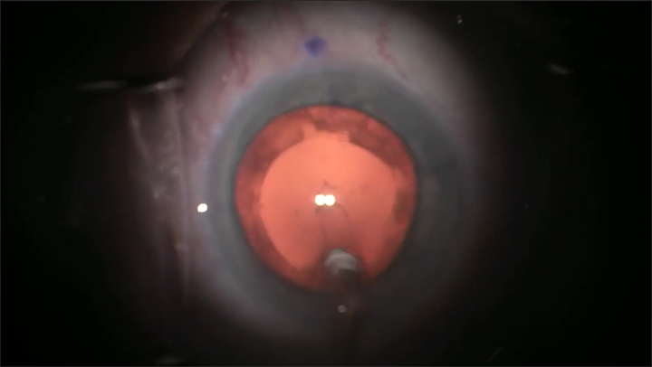 Management of Acute Intraoperative Rock-hard Eye Syndrome