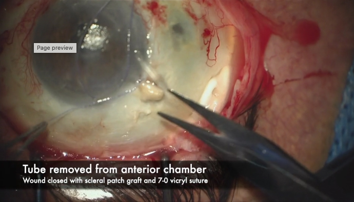 Surgical Revision of an Exposed Baerveldt Tube Shunt Associated with Scleral Melt