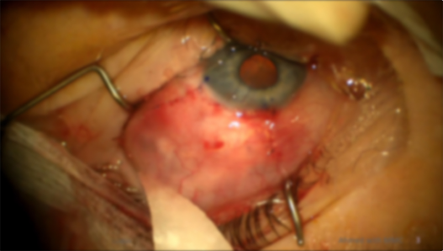 Using Mitomycin C With an Ahmed Tube Shunt