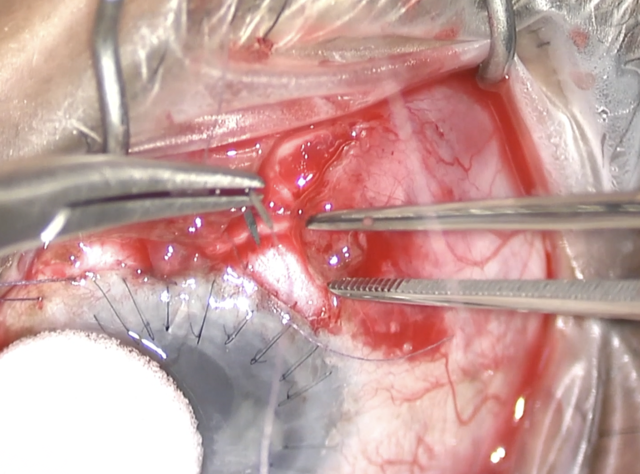 Tube Shunt Erosion Repair 